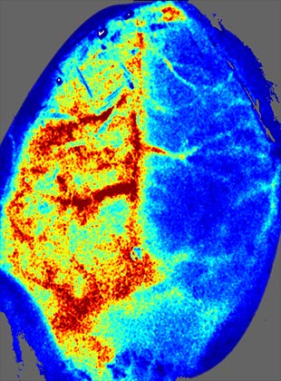 大腦中動脈缺血